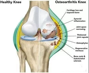 根治膝关节炎的特效药,我不是药神强直性脊柱炎