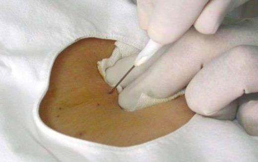 腰椎间盘突出通过扎针能否治愈,腰椎间盘突出最难恢复的就是腰痛