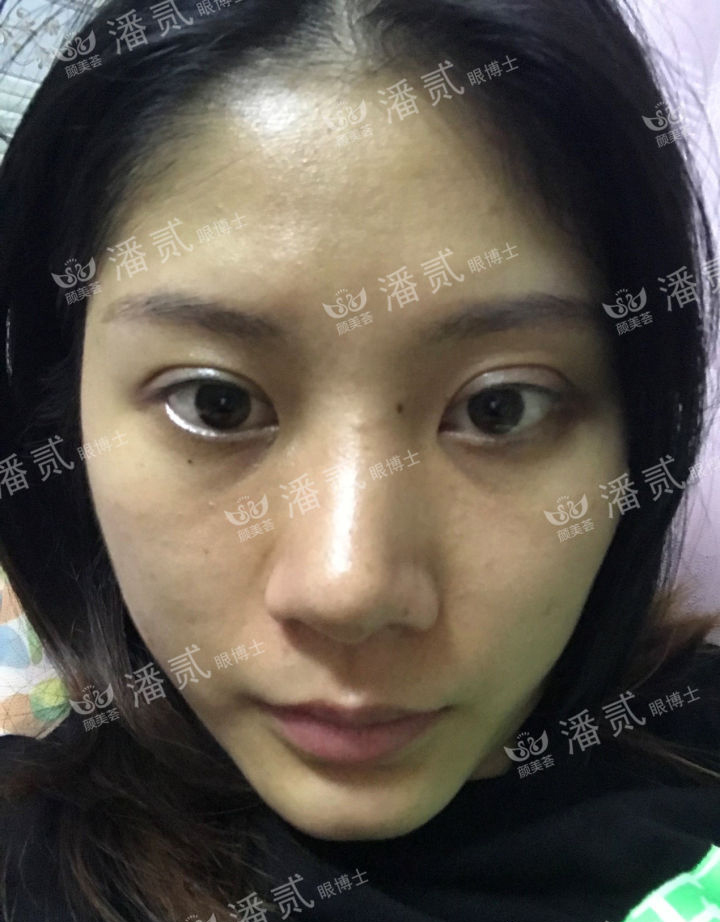 肿眼泡抽脂肪埋线双眼皮效果,肿眼泡割双眼皮长脂肪