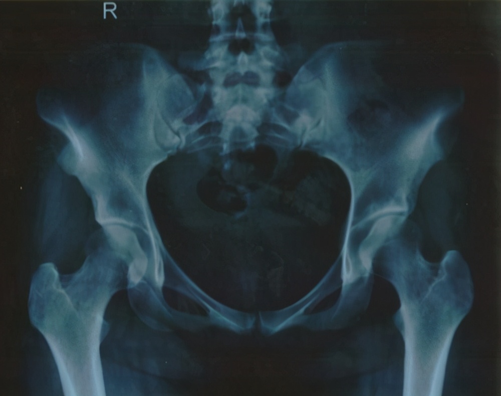 纤维性骨炎的主要病因,纤维性骨炎