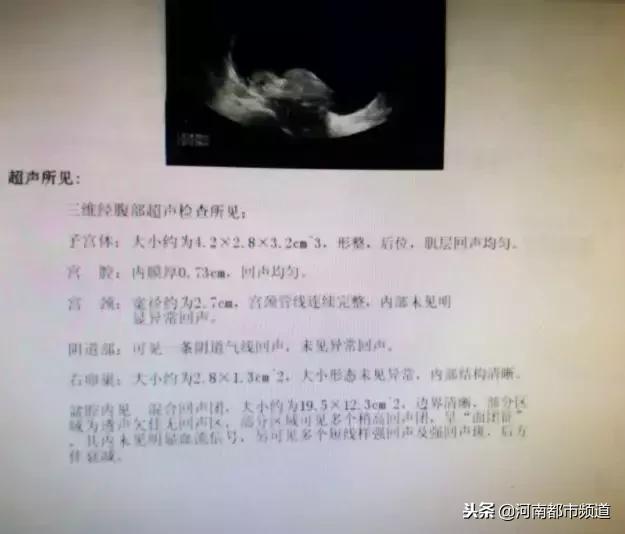 5岁女孩颅底长罕见肿瘤,11岁女孩头部长肿瘤