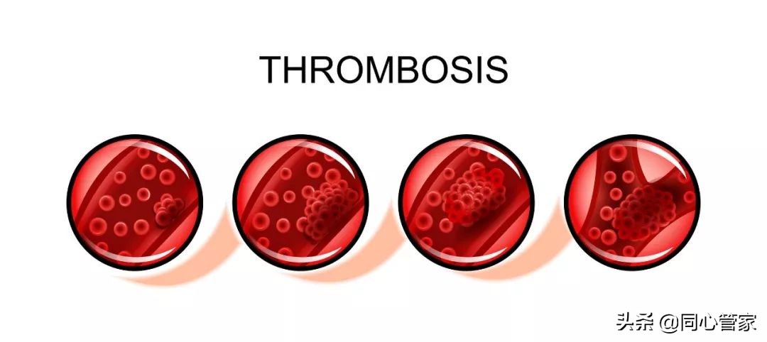 是不是有的血栓也不要过度治疗,能彻底治疗血栓吗