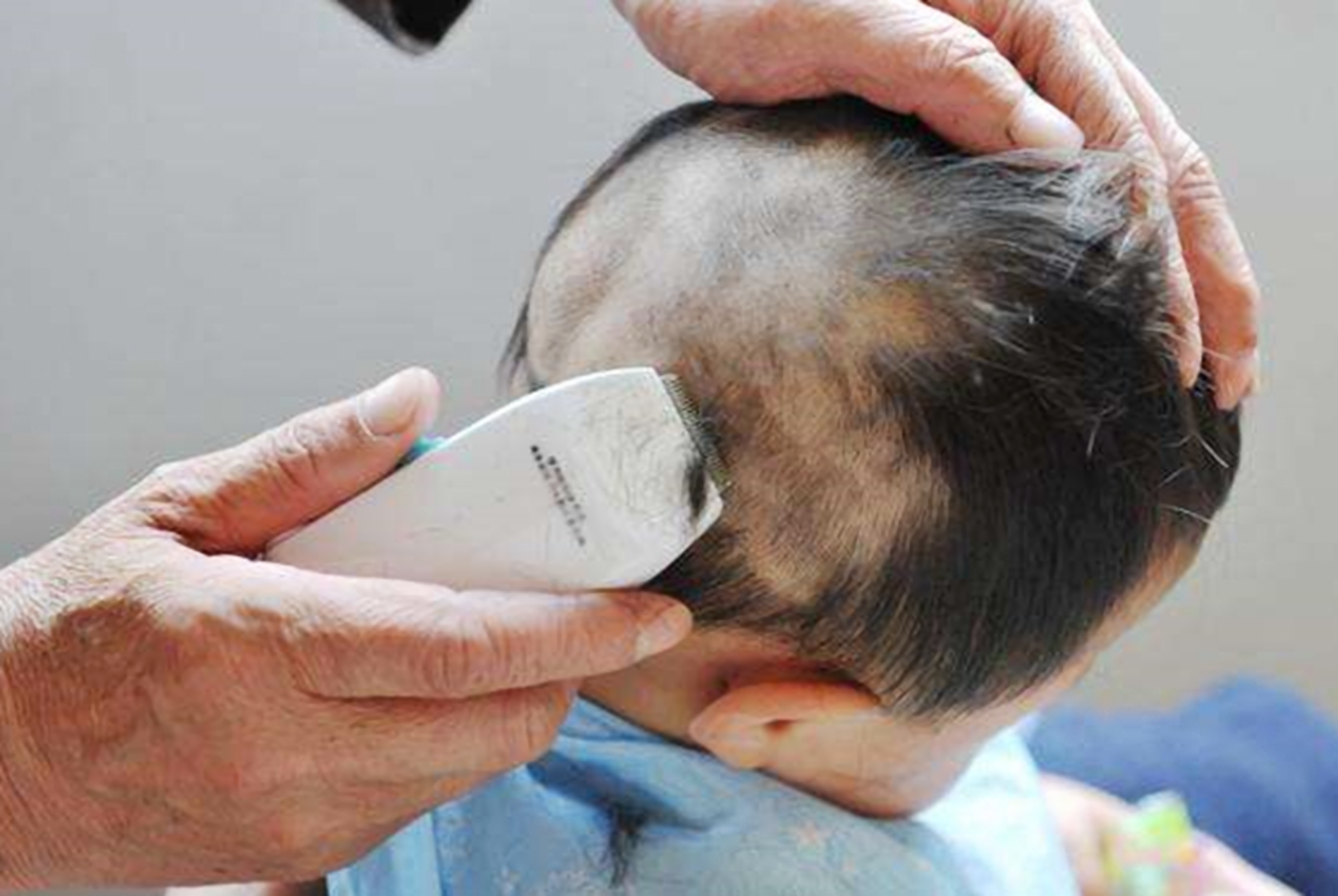 宝宝头上斑秃是什么原因造成的,是不是每个宝宝都秃顶