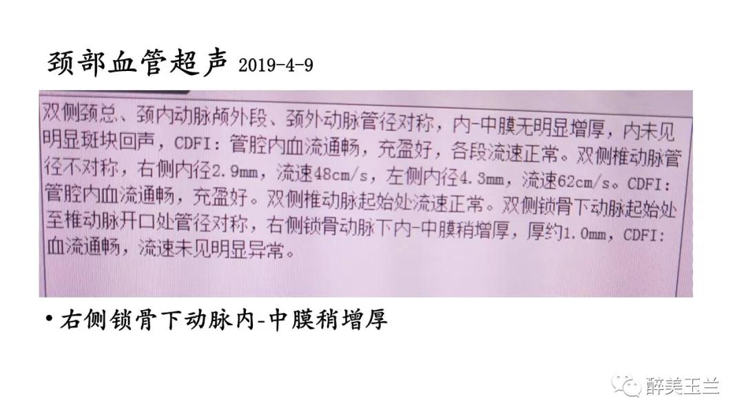 病例分享丨三叉神经节微球囊压迫术的麻醉管理