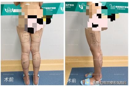大小腿吸脂后走路,大小腿吸脂可以修饰腿型吗