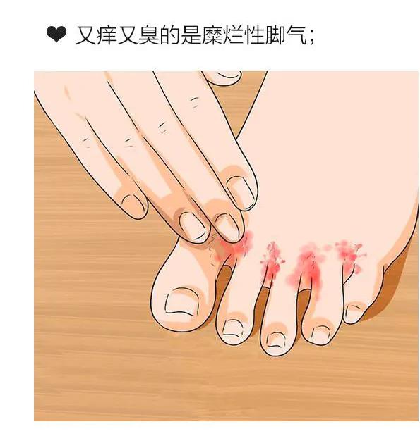 脚气奇痒又痛反复发作,脚气脚心痒痒难忍怎么办