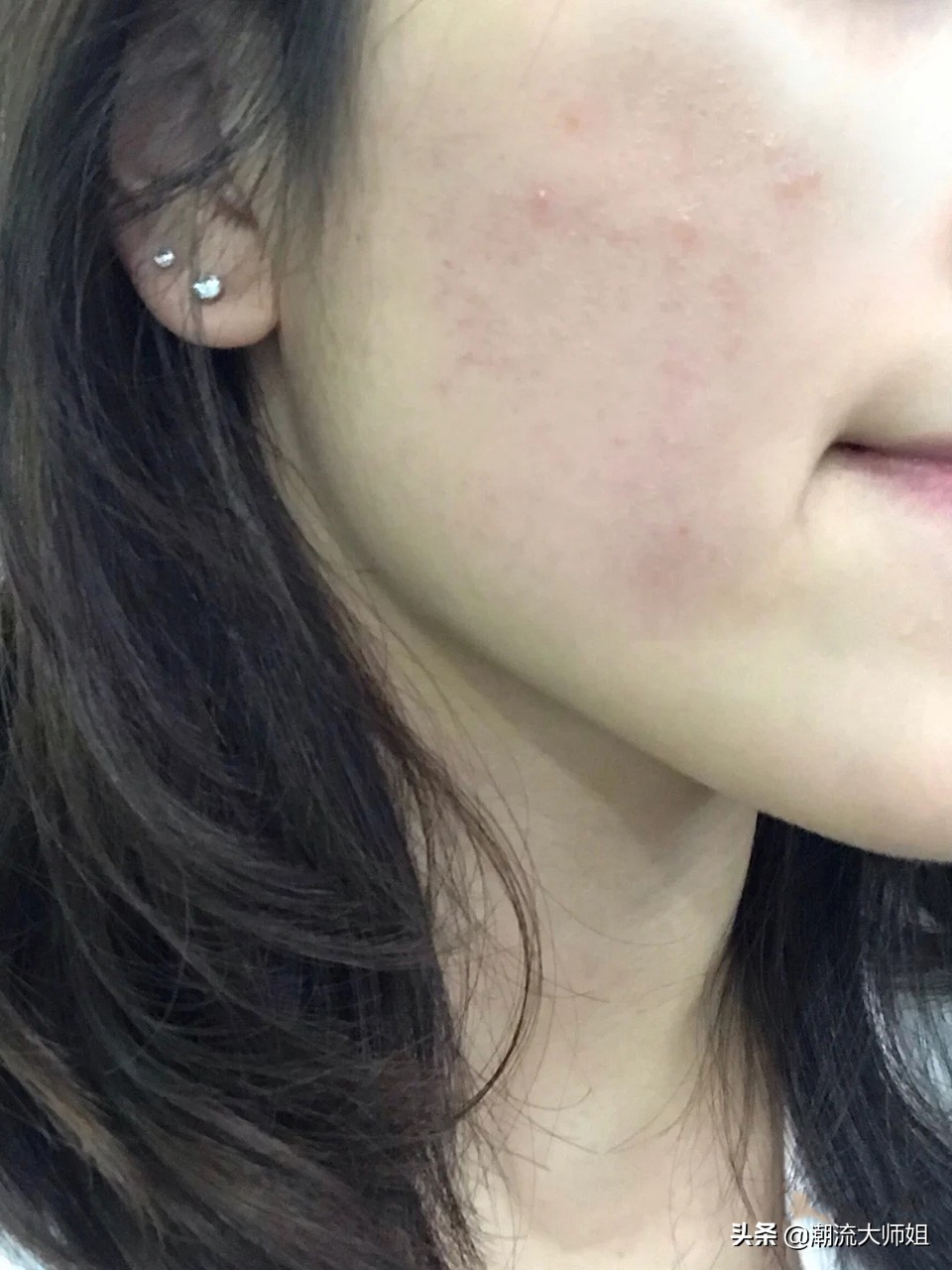 怎样才可以彻底告别痘痘肌,三招教你告别痘痘肌的烦恼