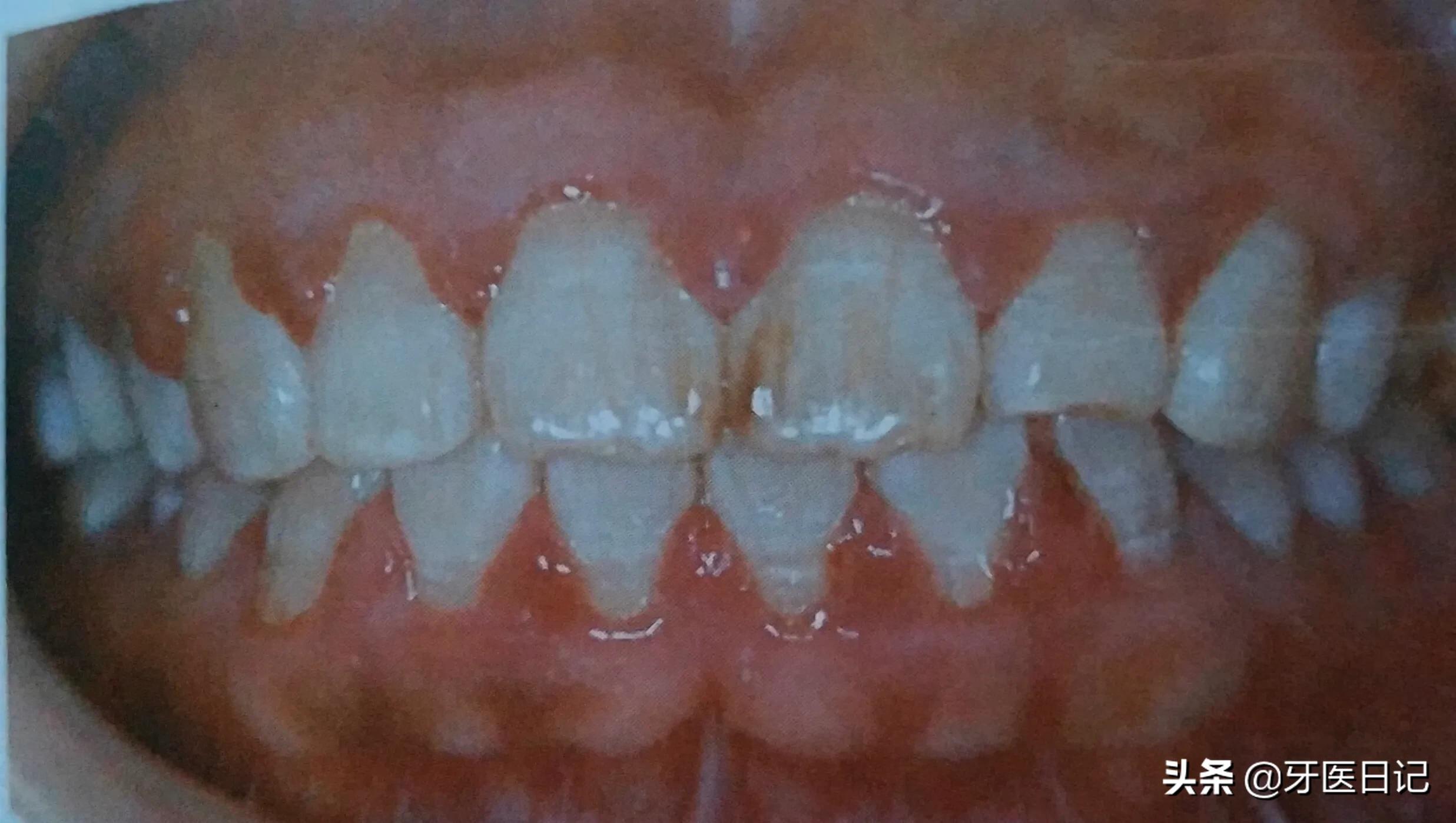 牙龈上火肿了吃什么药,牙龈肿了个肉坨上火疼