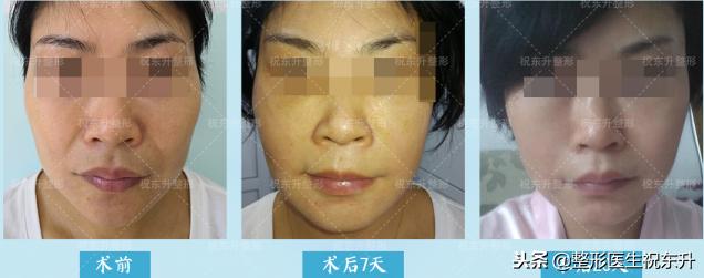 消除法令纹做什么项目,消除法令纹按什么穴