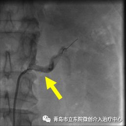 讲述一位高血压患者治愈经历,难治性高血压诊治图解