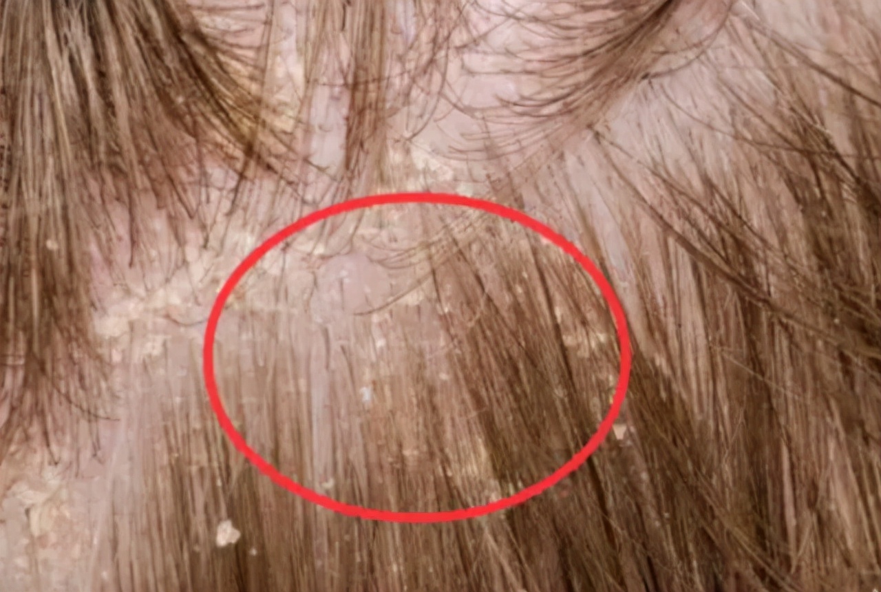 头皮上总出油长有疙瘩或脓包,头皮老是长疙瘩是咋回事