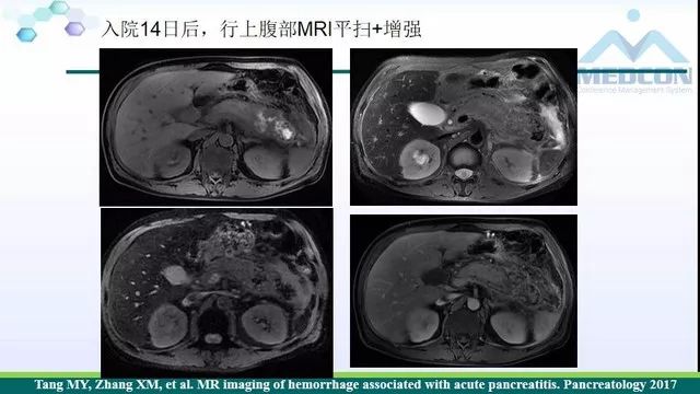 急性胰腺炎的护理措施,急性胰腺炎影像与临床