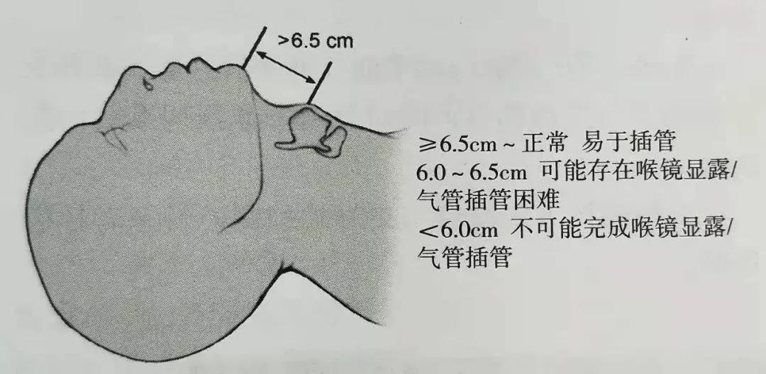 困难气道插管视频,困难插管