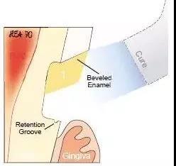 楔状缺损坑,较深的楔状缺损
