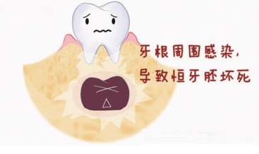 儿童蛀牙怎么在家补救,儿童蛀牙的正确治疗方法