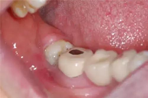 智齿冠周炎引起的下颌骨疼痛,智齿冠周炎张口受限伴吞咽疼痛