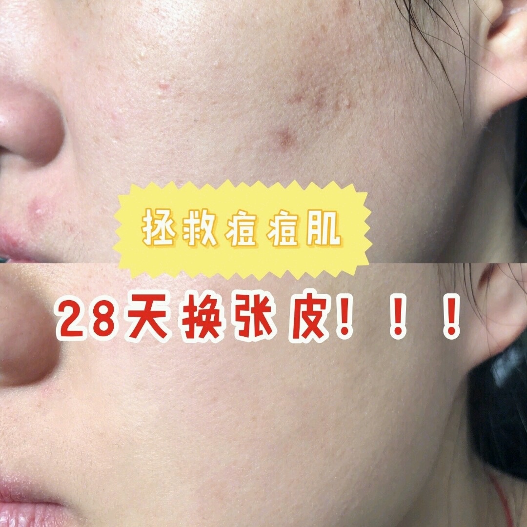 痘克清苦瓜祛痘膏测评,痘肌油皮护肤品大推荐