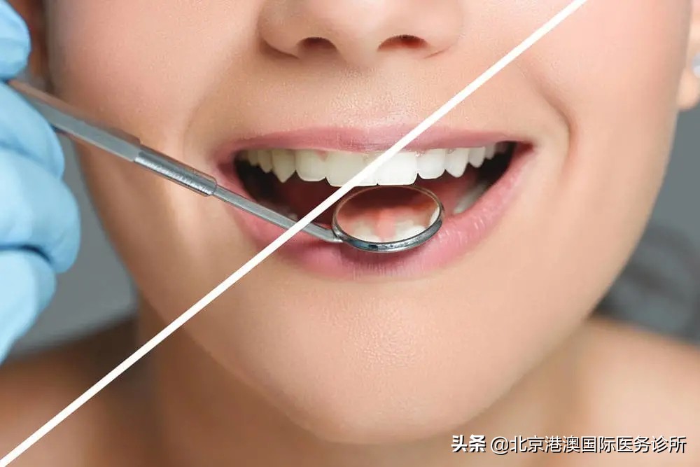 牙齿美白最好的方法用什么牙膏,牙齿美白到底什么才真正有效