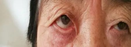 眼整形常见手术方式,眼整形美容手术