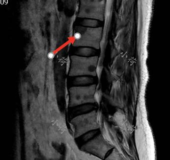 乳腺癌晚期骨转移内分泌治疗效果,乳腺癌骨转移中医成功案例