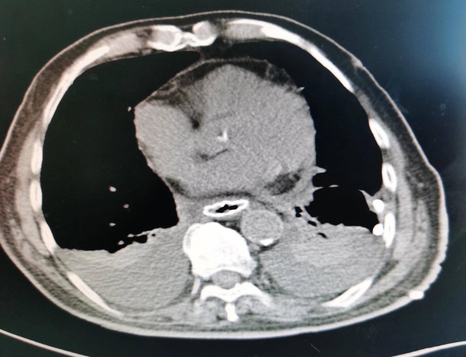 贲门癌吐血抢救,中国最著名的贲门癌治疗专家