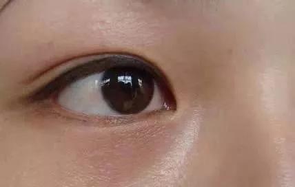 长了汗管瘤容易长皱纹,为什么会长汗管瘤和脂肪粒