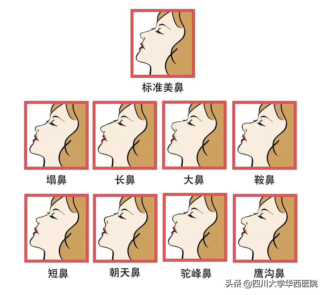 鼻子太翘怎么整形,鼻子太尖整形修复最佳方法