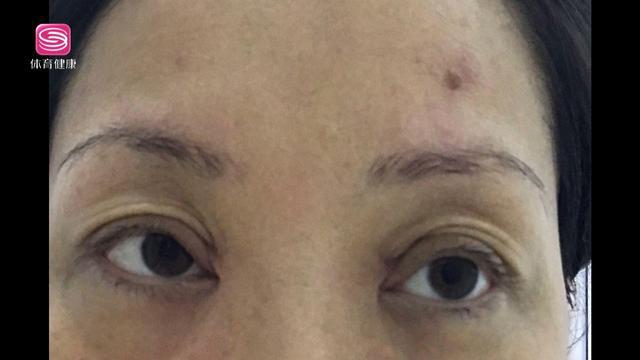 双眼皮变成三眼皮怎么变回双眼皮,双眼皮变成三眼皮可埋线修复吗