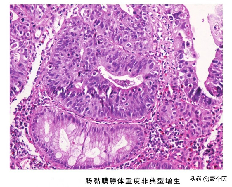 病理单上的癌前病变、非典型性增生及原位癌还是傻傻分不清？