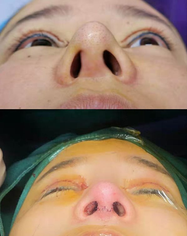一次隆鼻手术一般几个切口,山根低鼻梁塌鼻翼大怎么隆鼻