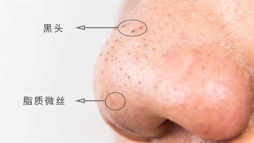 实用又不刺激的去黑头方法有哪些,祛黑头最好的方法目前最有效