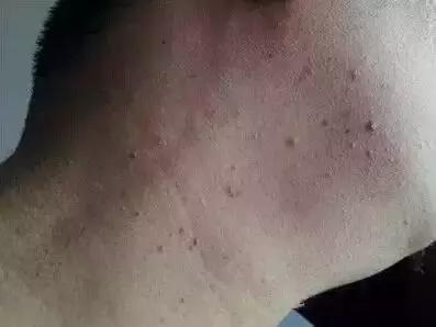 脖子上长痣小肉粒,脖子上长小肉粒要注意啦