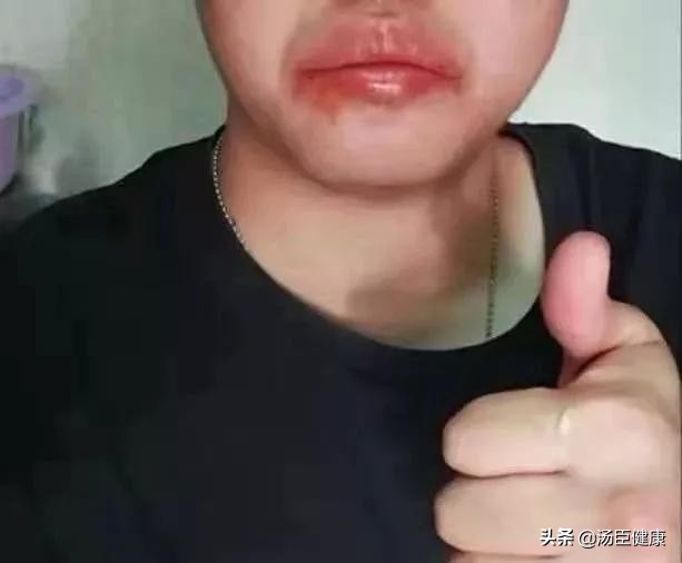 辣椒上火的表现,辣椒吃多上火长痘痘怎么办