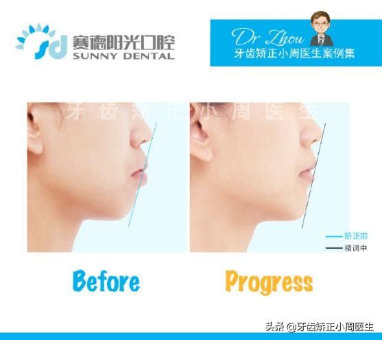 正畸牙齿打骨钉的危害,正畸打骨钉是什么感觉