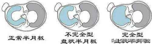 膝盖走路咯噔响还疼是什么原因,膝盖弯曲膝盖响是什么原因