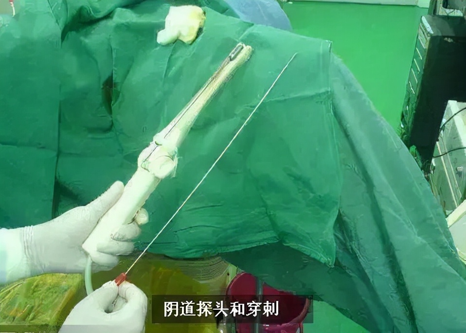 捐卵黑幕被曝光,捐卵骗局科普视频