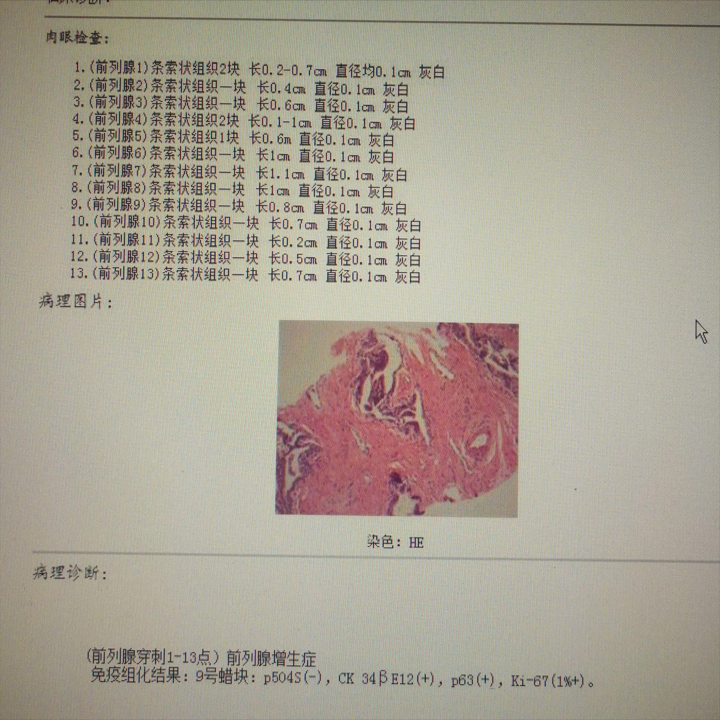 结节息肉囊肿增生哪个更容易癌变,结节囊肿增生息肉有什么区别