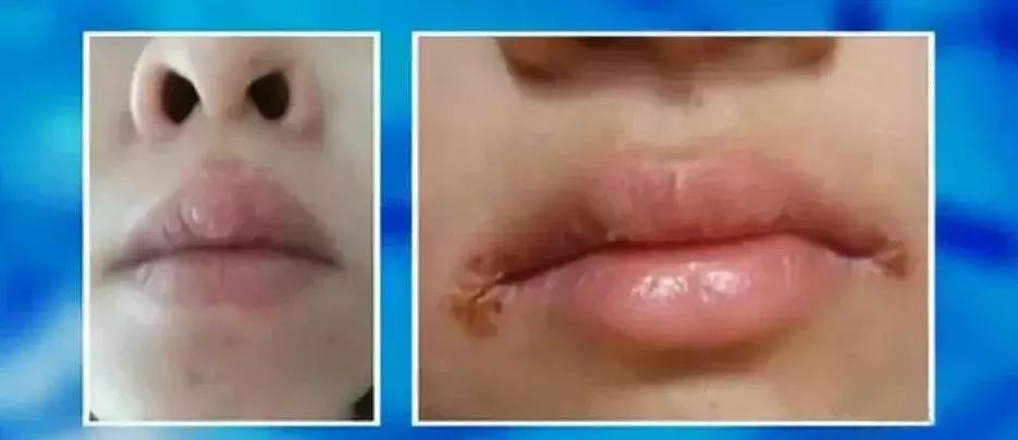 危险三角区会有什么症状,面部危险三角区有哪些危害