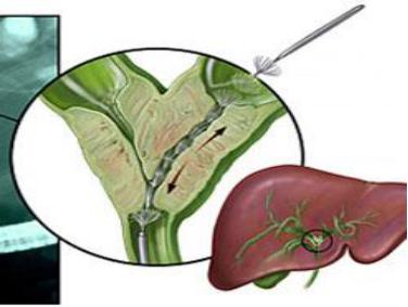 突发肚子疼呕吐是阑尾炎吗,突发恶心腹痛是什么原因