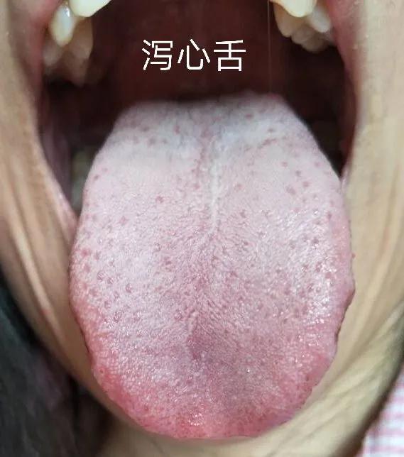 厥阴病脉证治疗方法,厥阴病的中医临床医案