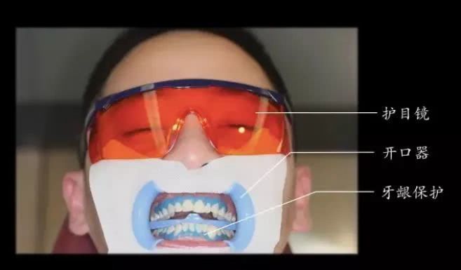 牙齿总是黄黄的?唯美口腔教你2个靠谱方法美白牙齿