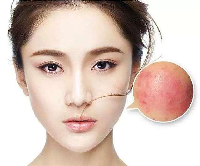 困扰我们的问题怎么解决,红血丝皮肤如何拯救