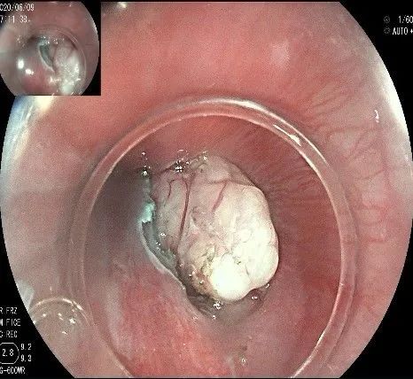 贲门隆起性病变影像,贲门溃疡隆起性病变