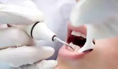 每年洗一次牙对牙齿有伤害吗,洗一次牙大概多少钱左右