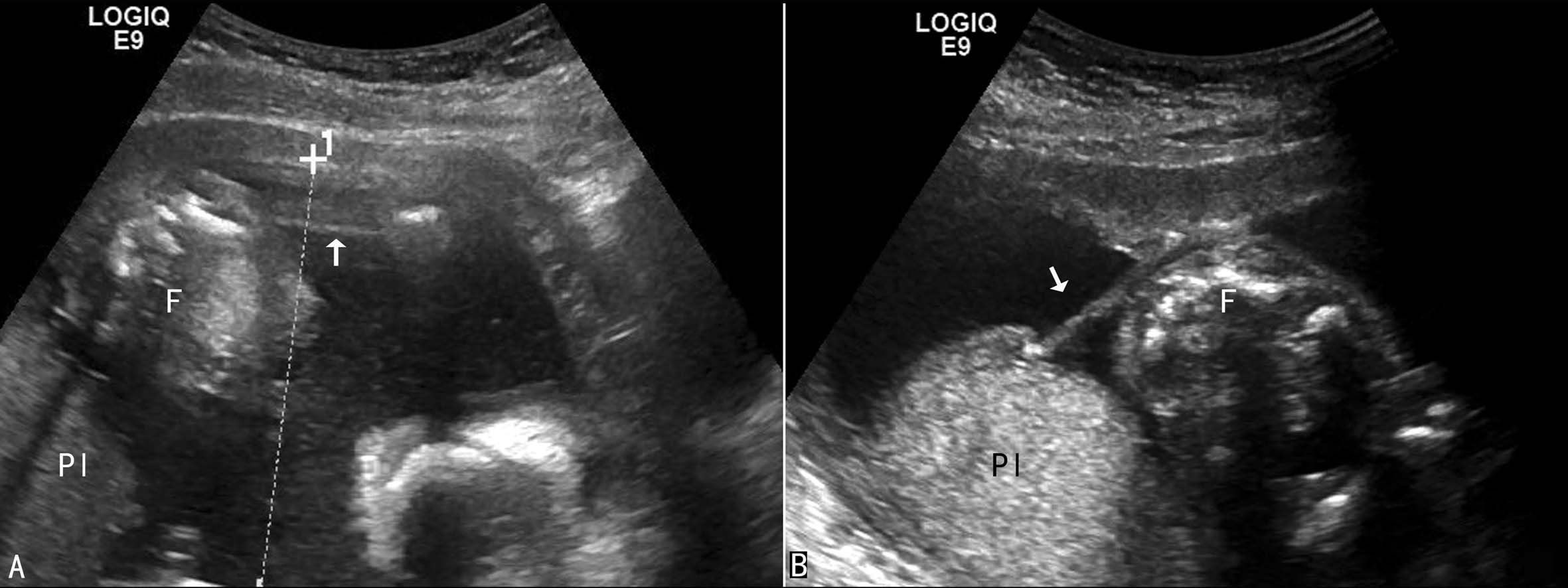 羊水彩超和普通彩超哪个更准,羊水异常的超声诊断