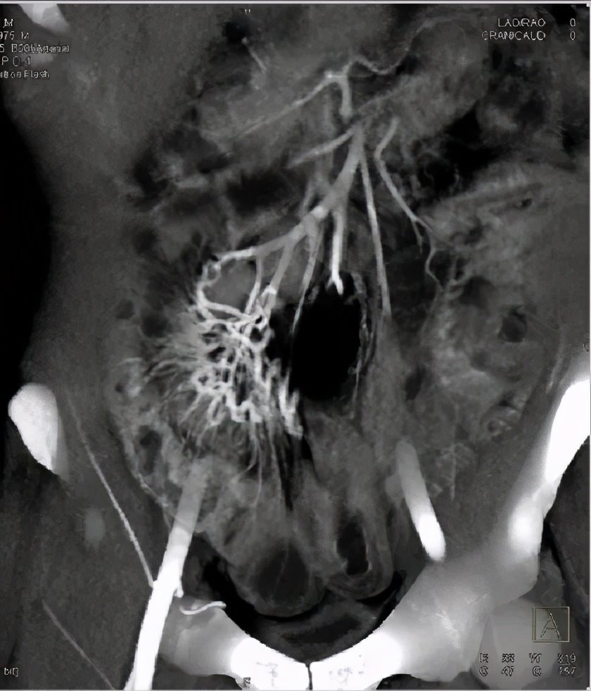 急性肠胃炎和肠穿孔,一种肠穿肚烂的疾病盯上青少年