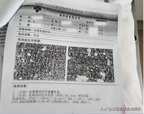 乳腺癌什么情况下可以保住乳房,乳腺癌美国被攻克了吗