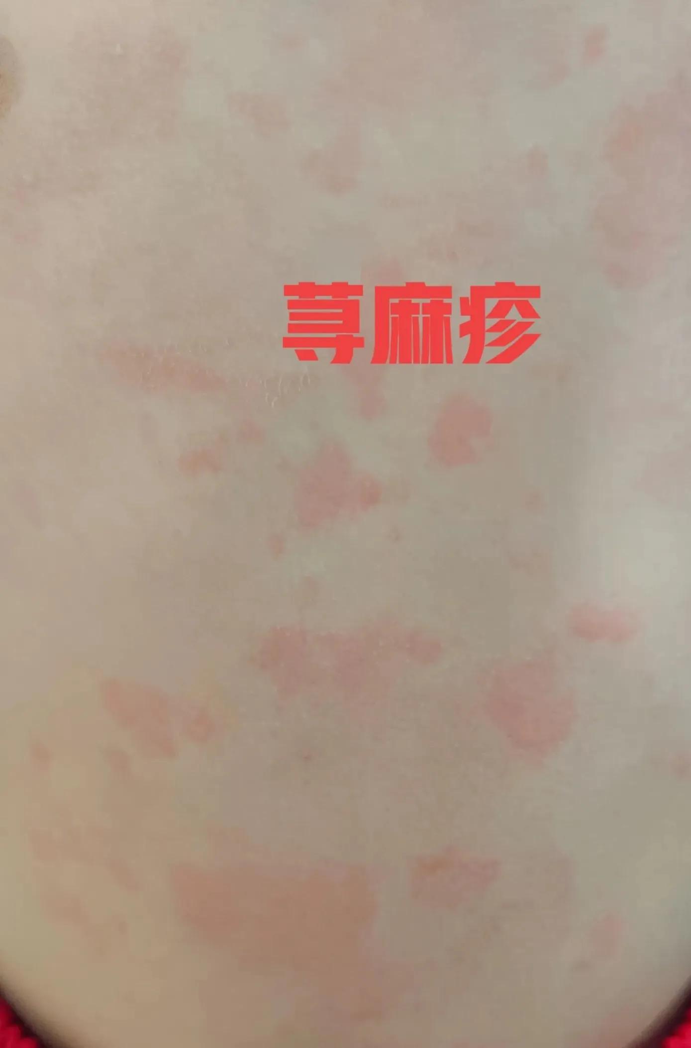 4种皮肤病最佳治疗方法,常见的手上皮肤病症状及治疗方法