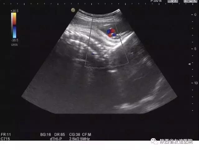 孕妇超声检查的几大误区,孕妇12周超声检查图片怎样看