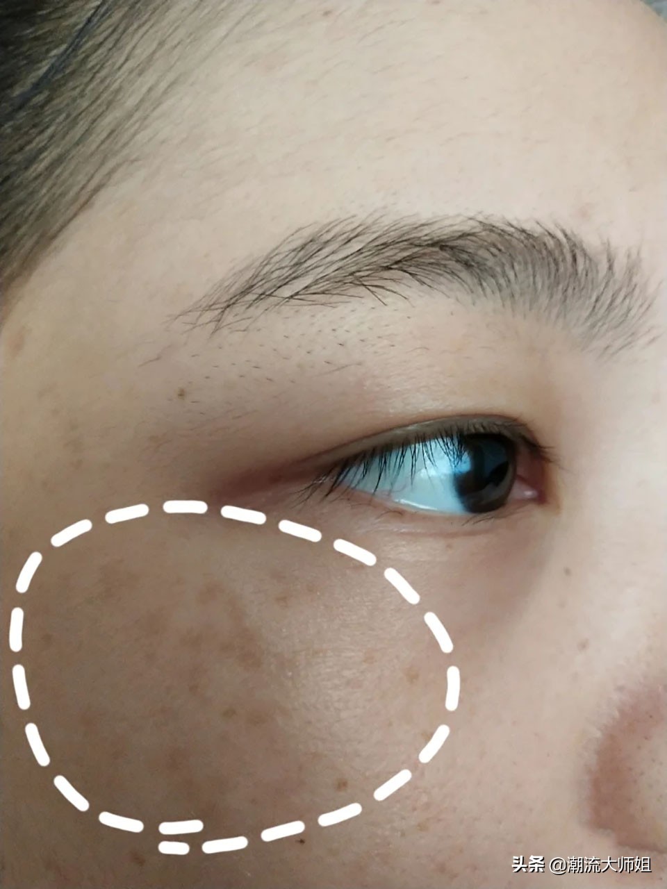 皮肤干燥又长斑先补水还是祛斑,长斑容易导致皮肤松弛